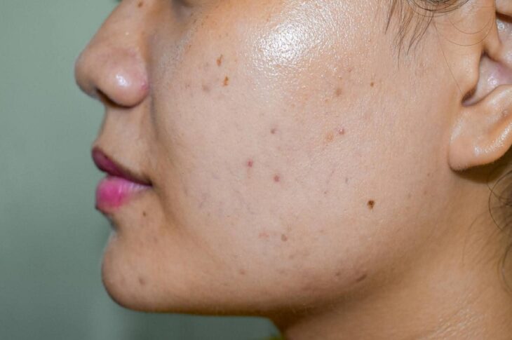 Goodbye to Dark Spots