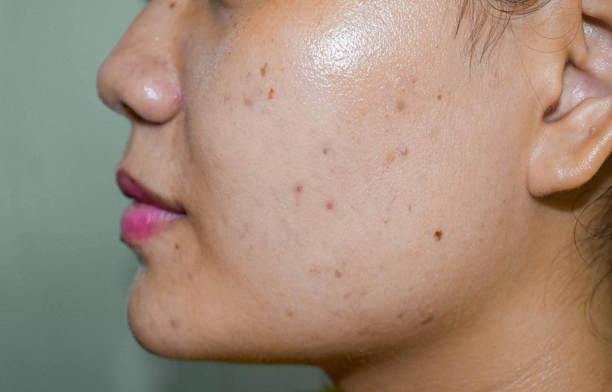 Goodbye to Dark Spots